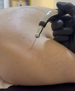 Dry needling treatment on a patient's back